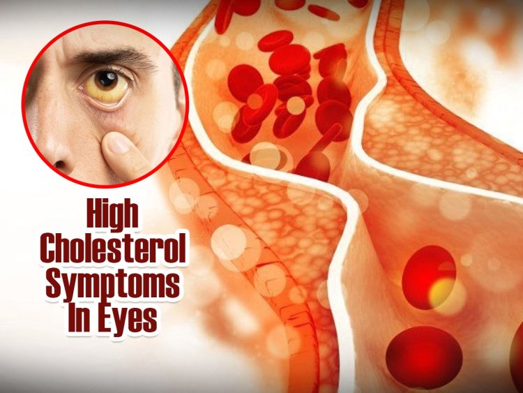 High Cholesterol  बढ़ने पर आंखों में दिखते हैं ये 3 लक्षण, नजरअंदाज करना पड़ जाएगा भारी...