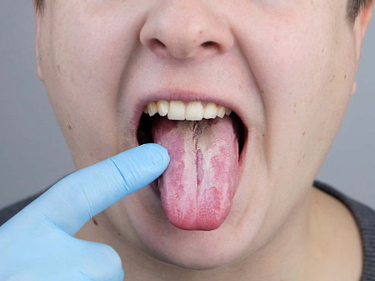 मुंह में होने वाले थ्रश फंगल इंफेक्शन के लक्षण और बचाव की होम रेमेडीज